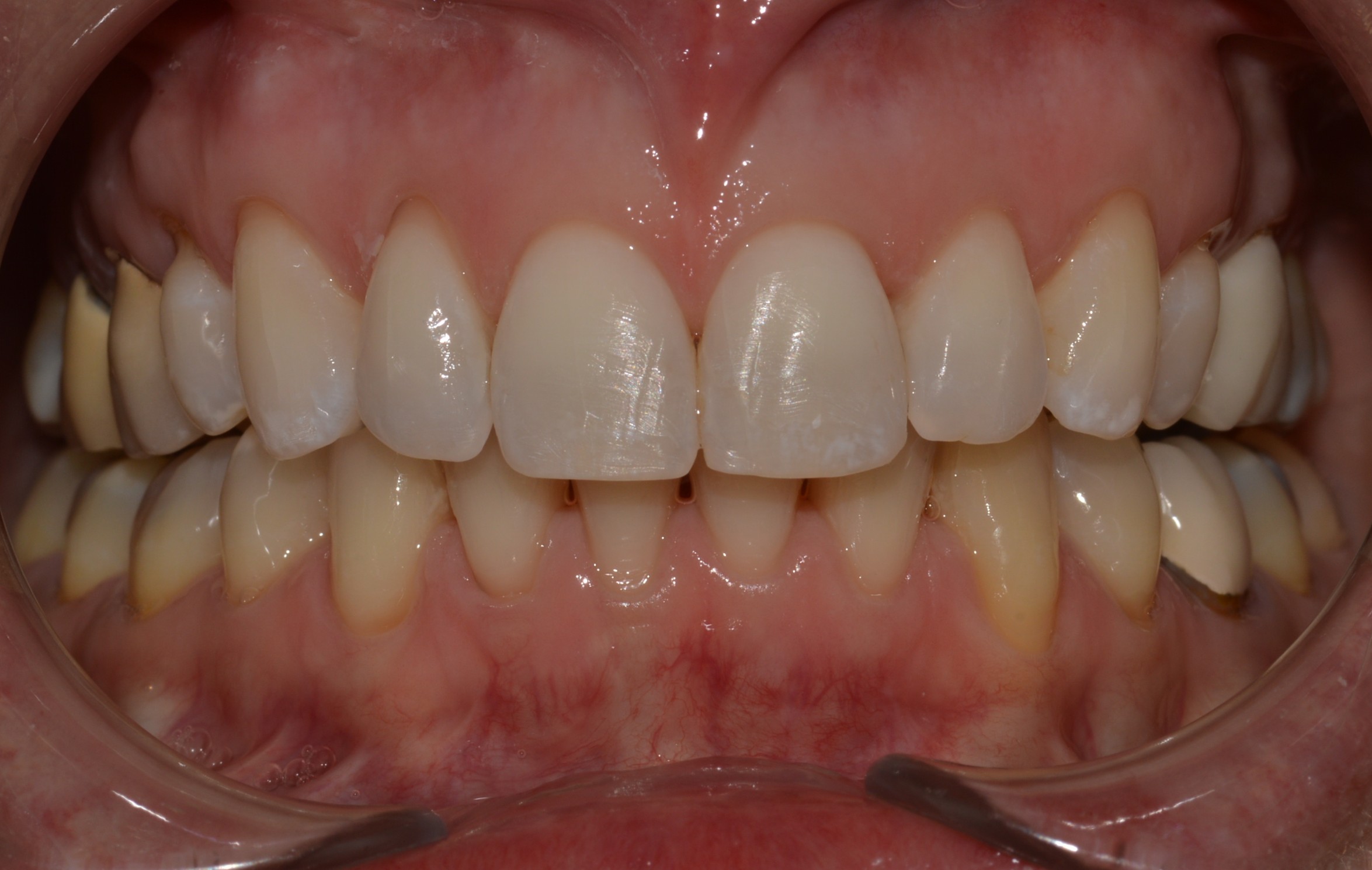 Underbite